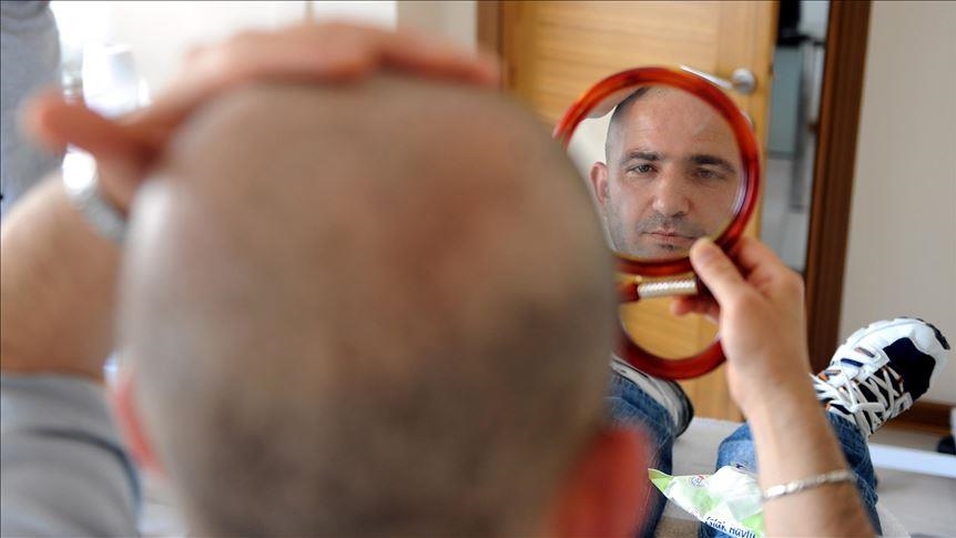 الأوروبيون يشكّلون 70 بالمئة من رواد زراعة الشعر في تركيا